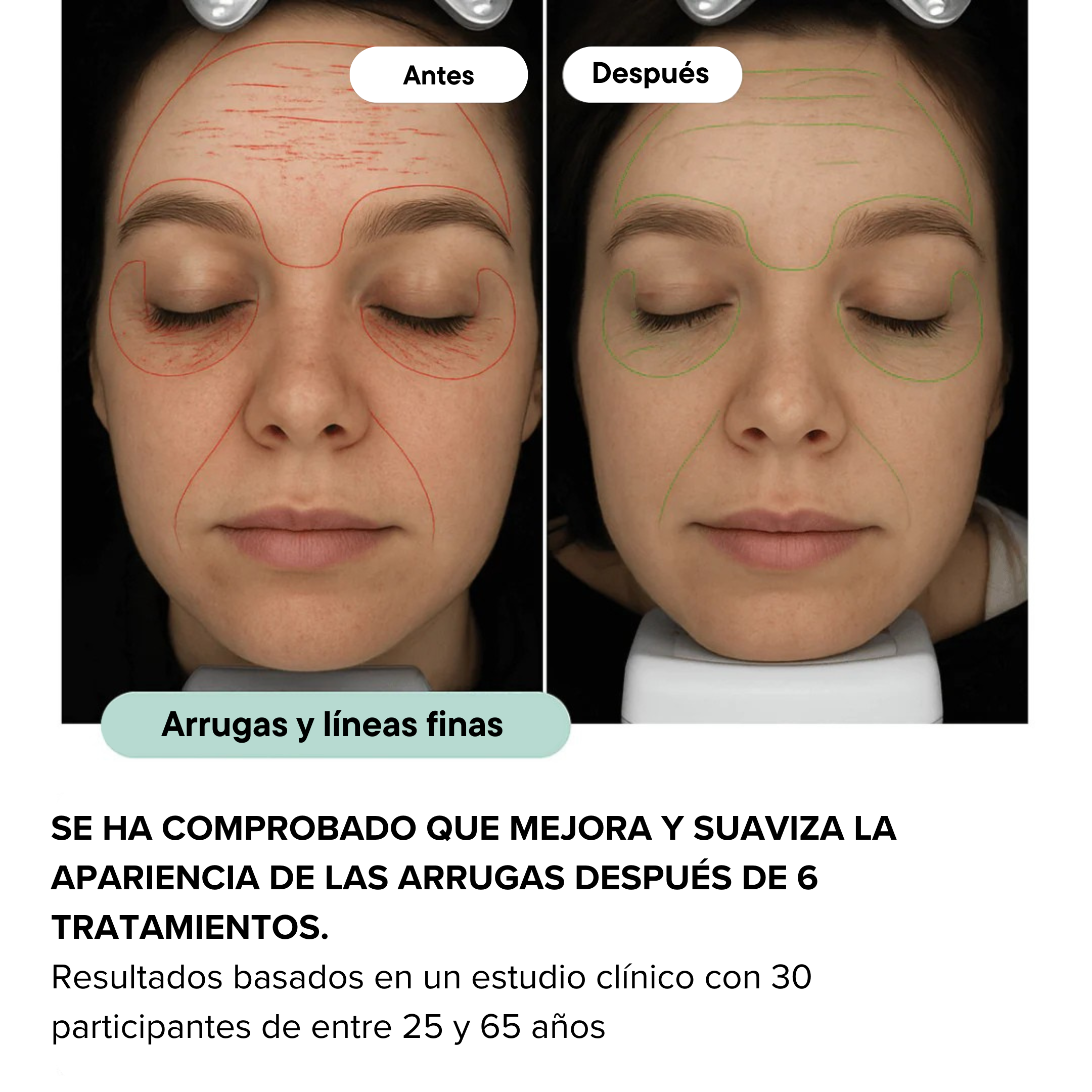 Sistema de Infusión Microneedling Anti-edad