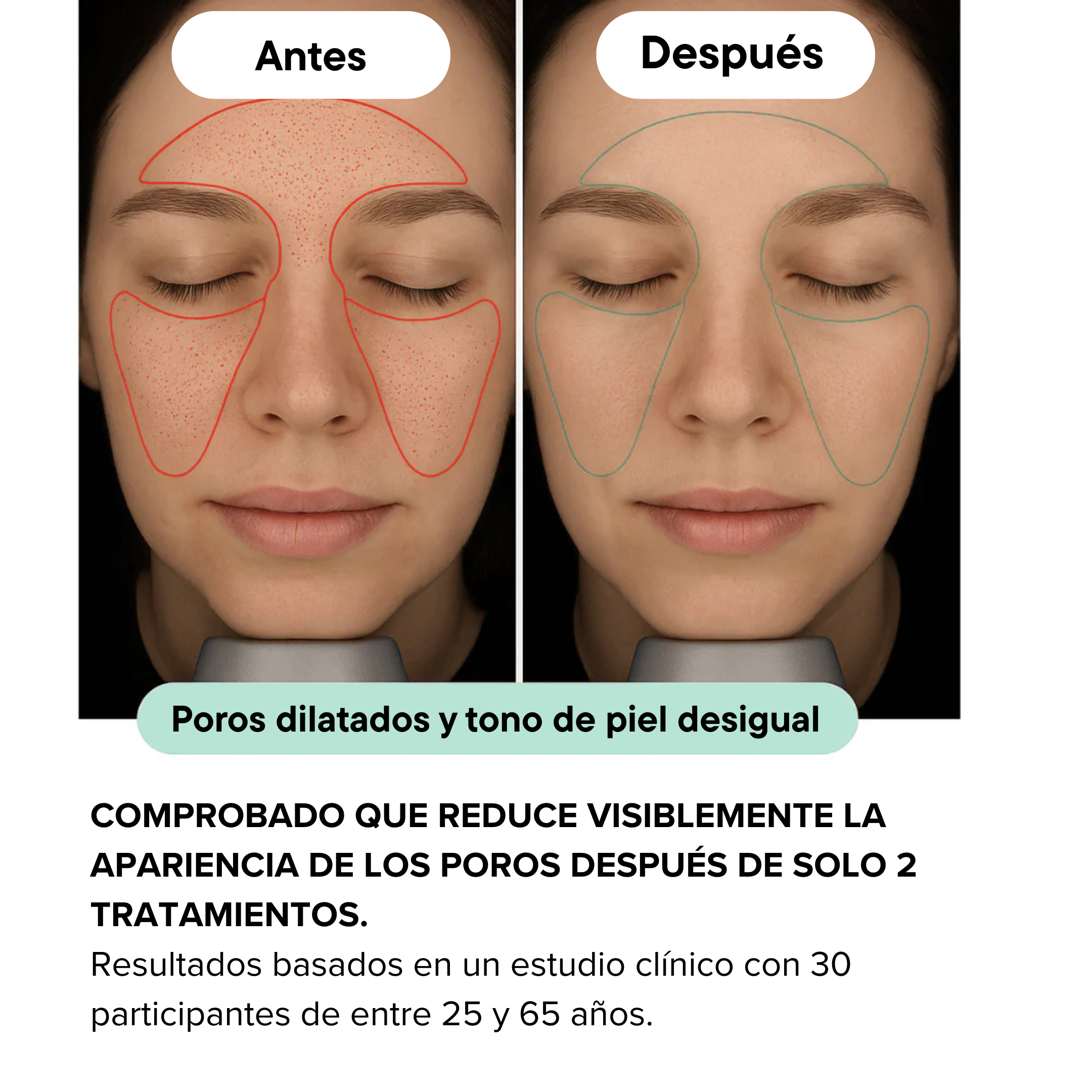 Sistema de Infusión Microneedling Anti-edad