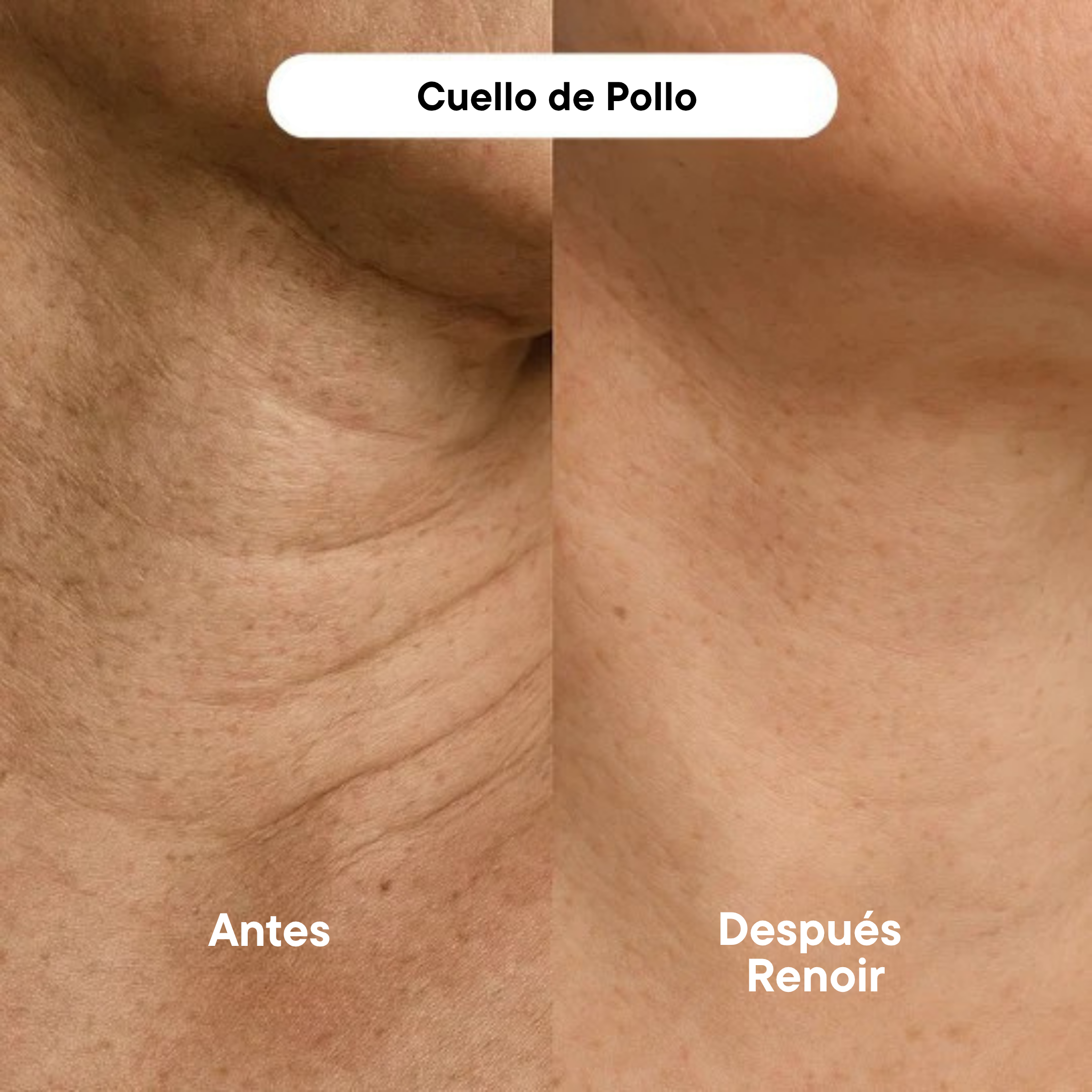 Sistema de Infusión Microneedling Anti-edad