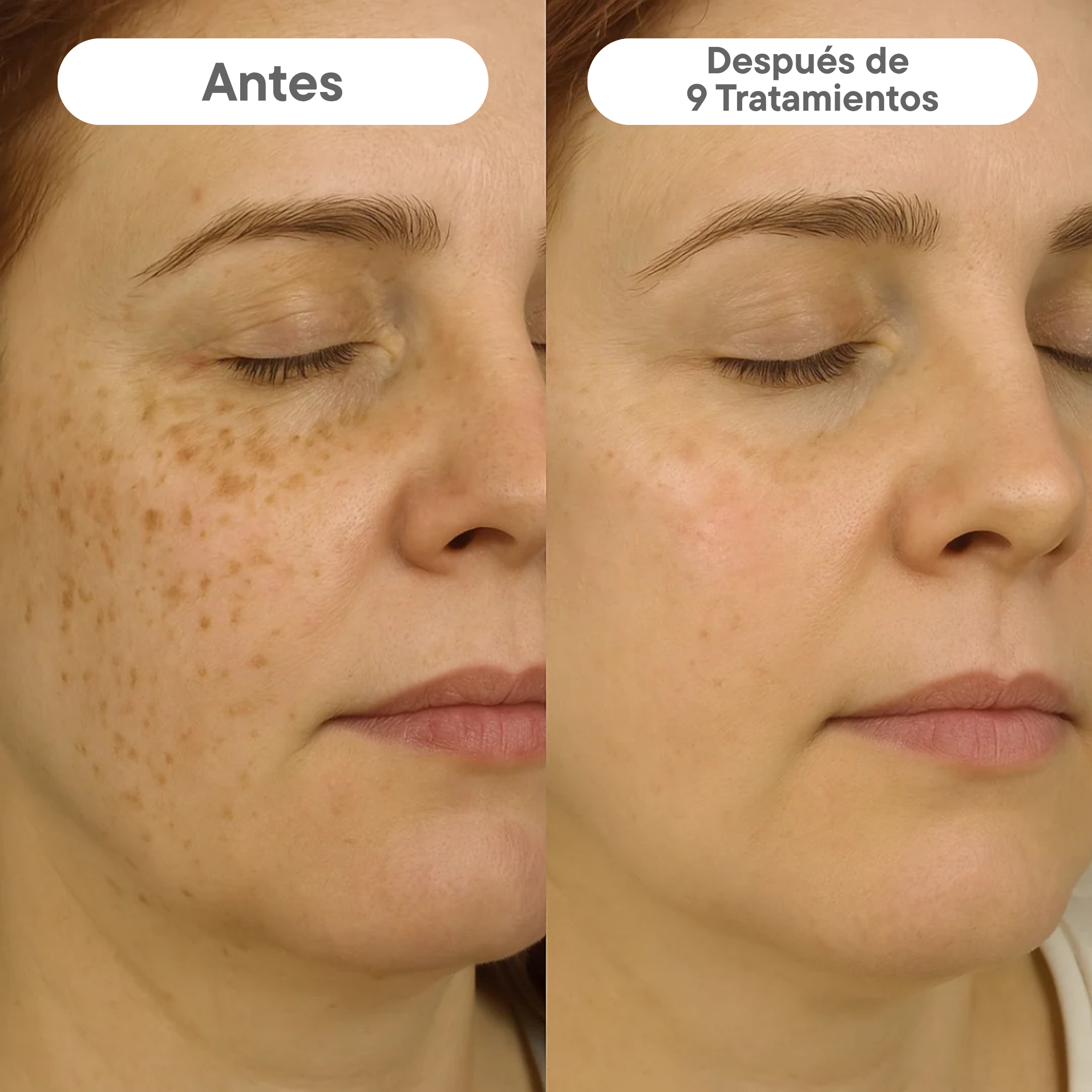 Sistema de Infusión Microneedling Anti-edad