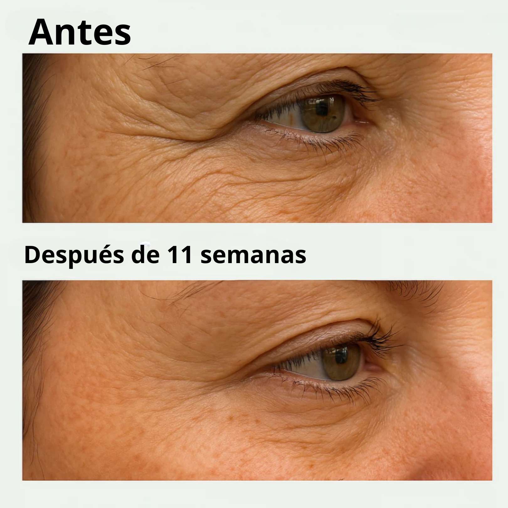 Parche Avanzado de Micro-Infusión